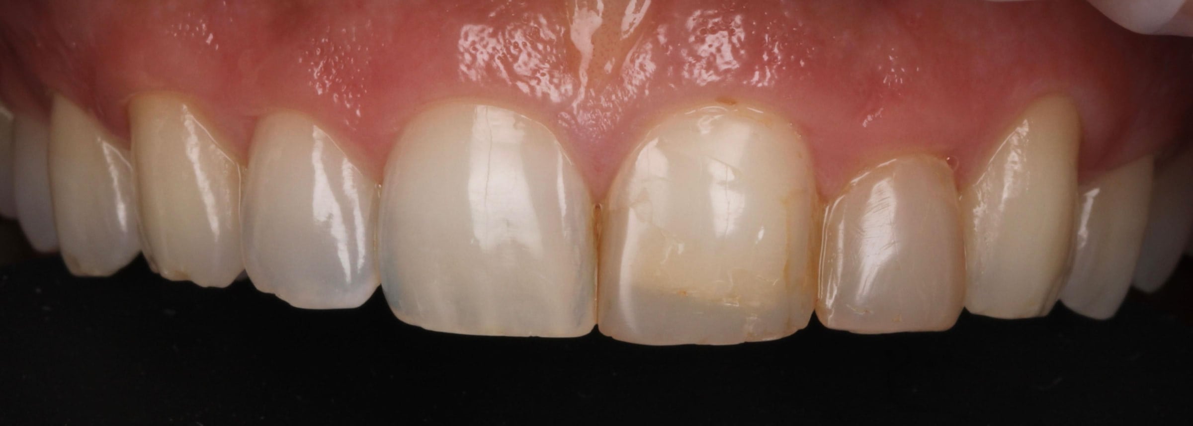 Retracted clinical photograph of the upper front teeth before treatment, showing worn incisal edges, uneven tooth lengths and a discoloured central incisor.
