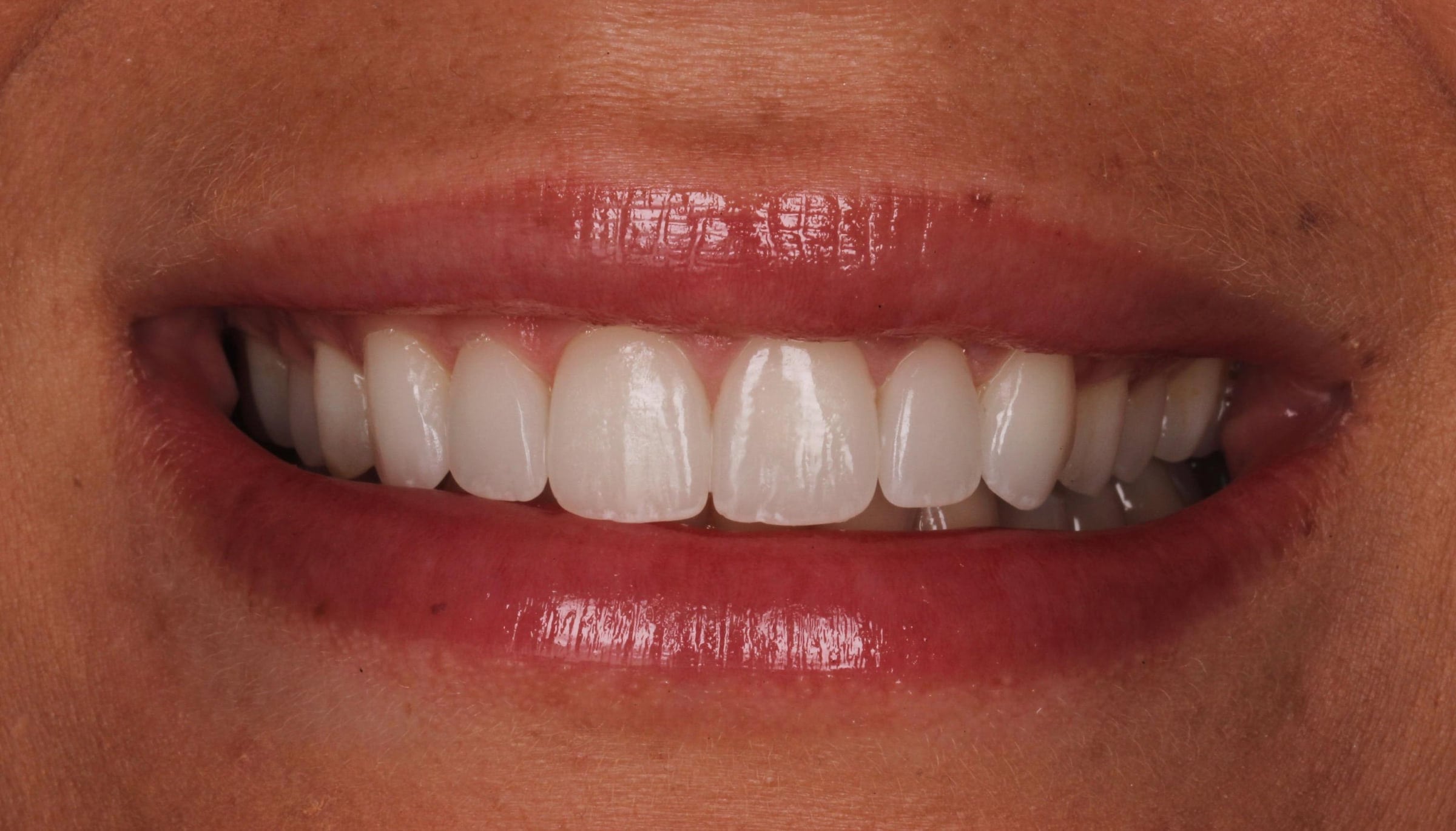 Close-up photograph of the same patient's smile after porcelain veneer treatment, with restored tooth length and a more even, natural shade.
